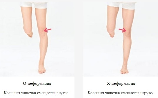 тест на смещение колена