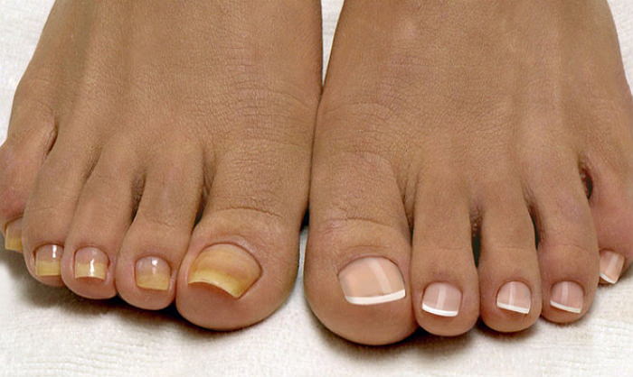 Ванночки от грибка ногтей на ногах: рецепты для лечения и профилактики