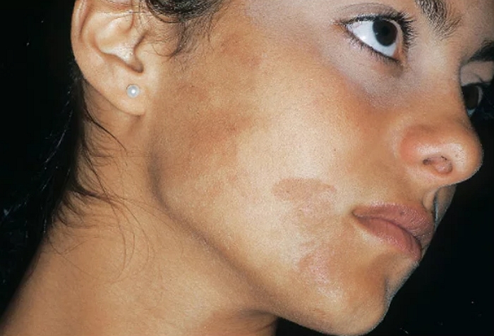 Гиперпигментация кожи